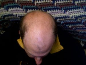 alopecia androgenica